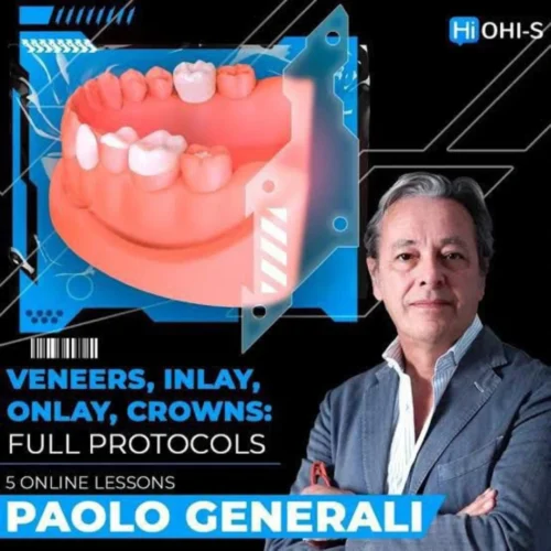 OHI-S Veneers, inlay, onlay, crowns full protocols OHI-S Veneers, inlay, onlay, crowns: full protocols