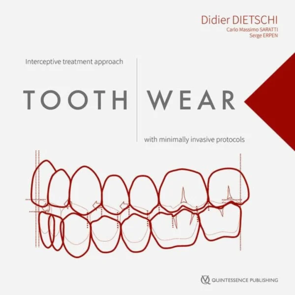 Tooth Wear Interceptive Treatment Approach With Minimally Invasive Protocols Tooth Wear: Interceptive Treatment Approach With Minimally Invasive Protocols