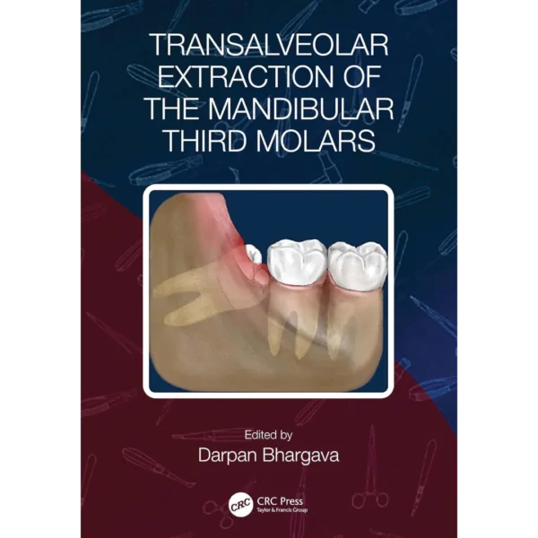 Transalveolar Extraction of the Mandibular Third Molars Transalveolar Extraction of the Mandibular Third Molars